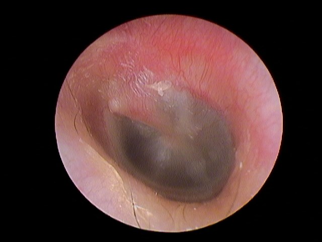 Эндоскопия уха